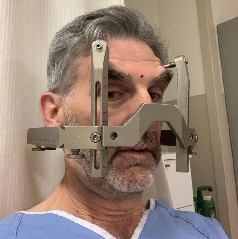A man wearing a blue surgery smock has been affixed by a complex metal surgical structure that is attached to several points of his head. 