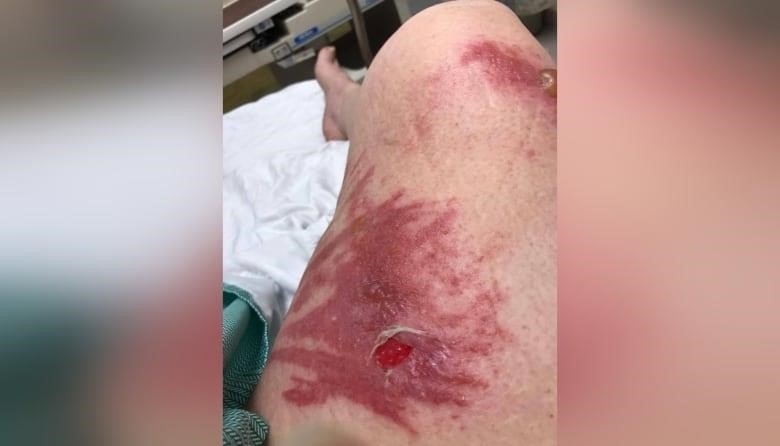 A woman's leg has severe burns, open sores, peeling skin and a pus-filled blister.